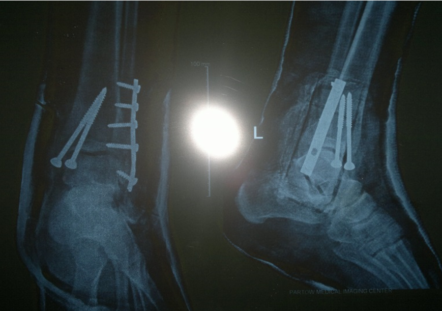 تصویر 3. عکس رادیوگرافی پای من بعد از عمل